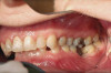 Fig 2. Example of a bite registration taken from a silicone tray.