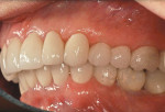 Figure 18  Posttreatment of left lateral view. Note the occlusal leveling of the maxillary occlusion line.