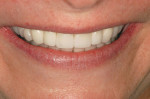 Figure 19  Close-up smile. Note the golden rule of proportion was applied to the restoration design.