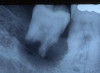 Figure 4. AND Figure 5. Before and after radiographs of bioceramic sealer hydraulically moved with the gutta-percha point. Note that the cold hydraulic technique results in lateral canal “puffs” similar to the warm vertical technique. Courtesy of Dr. Mohammed A. Alharbi.
