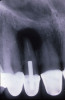 Figure 4. AND Figure 5. Before and after radiographs of bioceramic sealer hydraulically moved with the gutta-percha point. Note that the cold hydraulic technique results in lateral canal “puffs” similar to the warm vertical technique. Courtesy of Dr. Mohammed A. Alharbi.