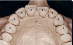 Figure 1  Implant distribution in maxilla.