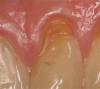 Fig 3. Patient No. 1, contralateral side; in 2009 patient presented with teeth Nos. 15 and 18. Subsequently, tooth No. 18 was extracted due to tooth fracture.
