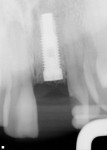 Figure 3  Implant placement.