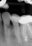 Figure 6  Clinical course of site development with subsequent implant placement and restoration. Initial presentation of external resorption and nonrestorable tooth No. 22.