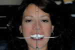 Figure 11  Use of Kois Dento-Facial Analyzer