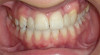 Fig 8. Eight months after grafting the extraction socket an implant was placed in a well-healed ridge. (Surgery in this case performed by Dr. Leventis.)