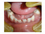Figure 1  The 4-year-old patient was missing a primary deciduous molar. The primary canine and secondary primary molar were etched and dried, then a bonding agent was applied.