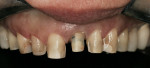 Figure 3  Tooth preparation, teeth Nos. 5 through 12.