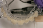 Figure 15  Vacuform matrix with composite placed against the labial internal surfaces of teeth Nos. 5 through 12.