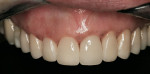 Figure 22  The porcelain veneers and crown on day of insertion.