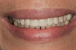 Figure 23  The porcelain veneers and crown on day of insertion.