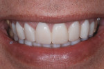 Figure 6  Anterior provisional restorations should reflect the planned final restorations.