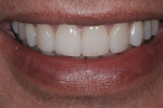 Figure 11  Postoperative smile view of completed case.