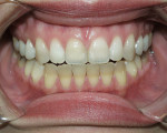 Figure 1  Completion of treatment after 6 months; starting shade C3 (seen on mandibular) and ending shade B1 (seen on maxillary).