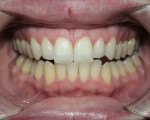 Figure 2  Completion of treatment after 3 months; starting shade B3 (seen on mandibular) and ending shade B1 (seen on maxillary).