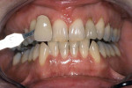 Figure 4  After 3 months of treatment, shade C2.