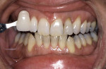 Figure 5  Completion of treatment after 6 months, shade B1.