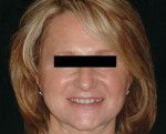 Figure 1  Fig 1. Pretreatment full-face image of the patient in smile.