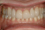 Figure 11  Posttreatment image of the patient’s teeth in maximum intercuspation. Note the stable periodontal health.