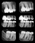 Figure 1  Circumferential bone loss is evident around tooth