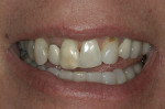 Figure 2  The patient was unhappy with the appearance of her teeth.