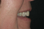 Figure 3  The patient was displeased with the appearance of some of her restorative dentistry.