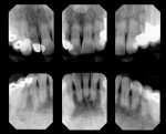 Figure 6  Root resorption on the anterior teeth contributed to a compromised crown-to-root ratio.