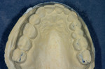 Figure 11  Deprogrammed mounting indicating tooth No. 2 as the primary contact.