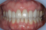 Figure 15  Crown form and tissue correction improved the ectopic tooth positions.