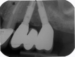 Figure 8  Representative periapical radiograph of a partial rehabilitation in the posterior maxilla (left) with the anterior implant placed in the axial position and the posterior implant tilted distally. Implants with 5 years of follow-up.