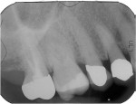 Figure 3 This patient had constant pain in the right maxilla for weeks, but this periapical radiograph failed to show any pathology.