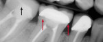 Figure 4 Final postoperative radiograph of tooth No. 31 showing excellent marginal integrity/accuracy of digital impression (black arrow) compared to traditional impression techniques used on tooth No. 30, which left multiple marginal voids (red arrows).