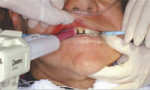 Figure 1 The best and most accurate technique is to have the patient close into centric occlusion with the assistant prelocking the occlusal registration strip in the preselected place. Then, the dentist syringes in the bite registration material without 