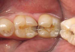 Figure 2 A preoperative photograph of teeth Nos. 18 and 19. Radiographs revealed caries under old restorations.