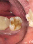Figure 6 View of the preparation after amalgam and caries removal.