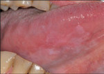 Figure 3 Unaided visualization. Photograph courtesy of the British Columbia Oral Cancer Prevention Program.