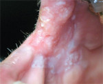 Figure 1 Verrucoid leukoplakia of the right commissure and anterior buccal mucosa. The biopsy indicated severe epithelial dysplasia.