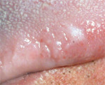 Figure 3 Small leukoplakia of the left mid-lateral border of the tongue. Lesions this size can possess significant dysplasia or early invasive squamous cell carcinoma.