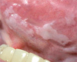 Figure 4 Extensive, scattered, and discontinuous leukoplakia of the left lateroventral tongue. This is an example of the concept of 