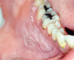Figure 5 Smokeless tobacco lesion of the anterior mandibular vestibule with the characteristic 