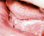 Figure 6 Left anterior floor-of-mouth leukoplakia with skip areas crossing the midline.