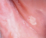 Figure 7 Subtle, diffuse leukoplakia of the left retromolar pad and a separate leukoplakia of the inferior, posterior buccal mucosa adjacent to the vestibule.