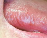 Figure 8 Right lateral tongue leukoplakia that, upon incisional biopsy, demonstrated mild epithelial dysplasia.