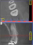 Figure 7 Views for fracture detection.