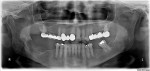A panoramic radiograph 2 months after the initial presentation showing persistent mottled, mixed, irregular radiolucent-radiopaque appearance, which was more extensive than seen on the previous panoramic image. Second lower right molar is removed.