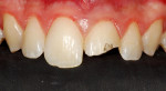 Figure 1 Clinical appearance of fractured maxillary left central incisor.
