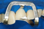 Figure 8 Tooth appearance after the removal of unsupported enamel.