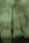 Figure 4 Periapical radiography.