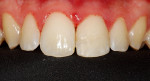 Figure 19 Tooth appearance after the esthetic restorative treatment.